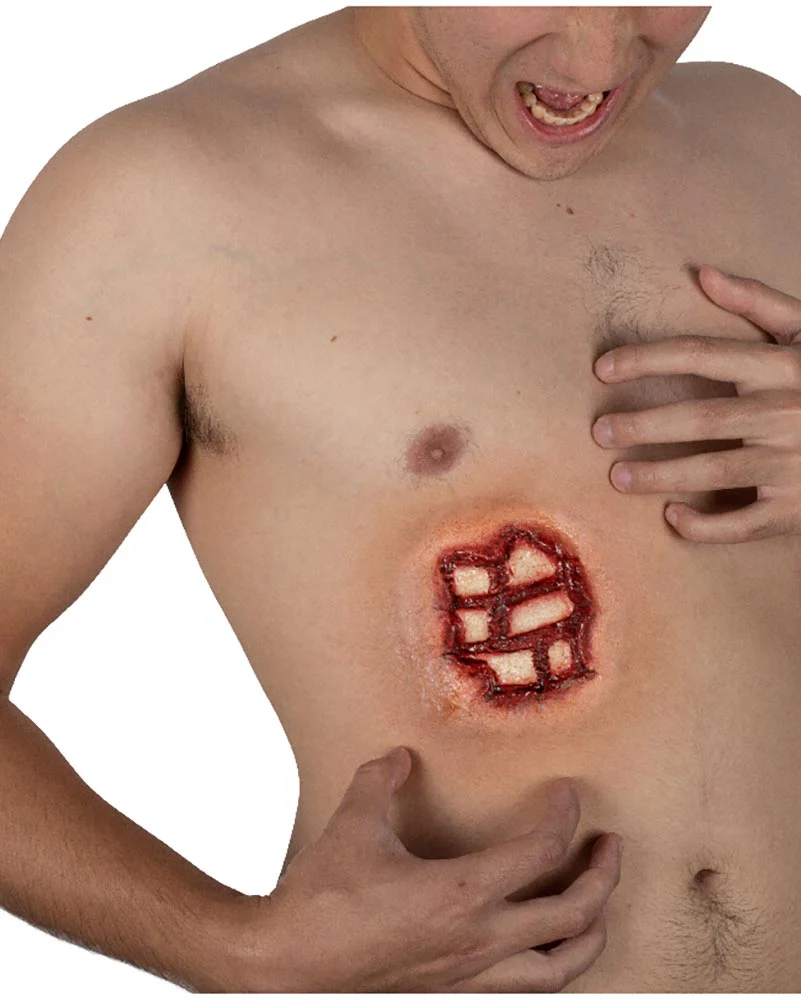 Rib Injury FX Appliance Transfer Prosthetic Wound